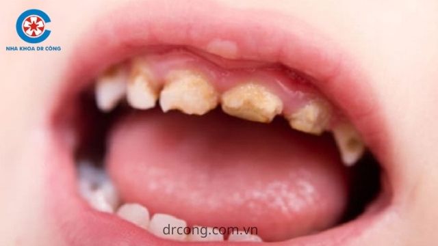 cách chăm sóc răng miệng cho trẻ