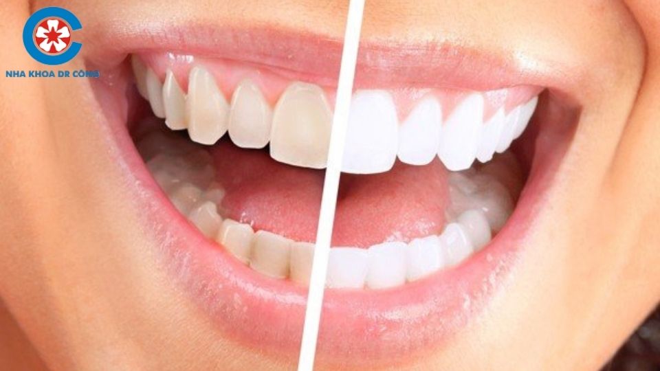 Có Nên Tẩy Trắng Răng Không? Tẩy Trắng Răng Ở Đâu Tốt tại HN