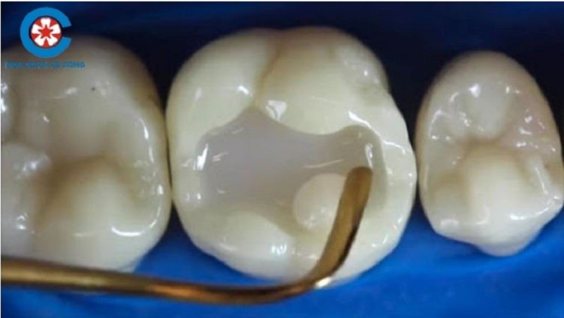Quy trình trám răng trực tiếp
