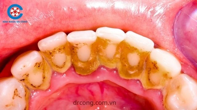 vôi răng là gì
