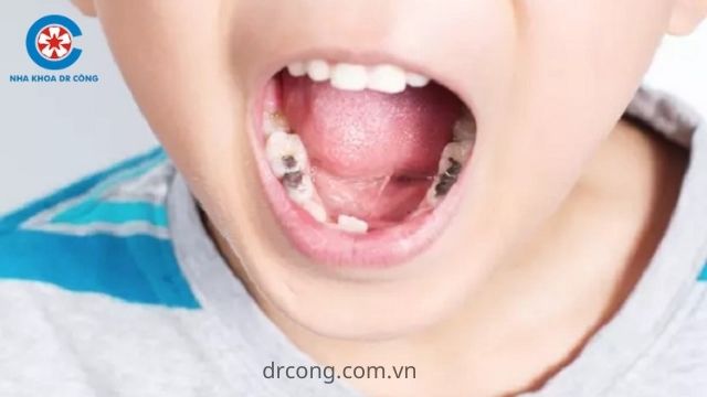 bệnh lý răng miệng ở trẻ