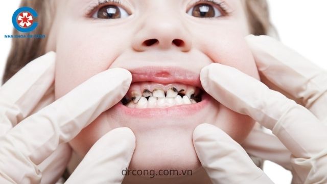 bệnh lý răng miệng ở trẻ