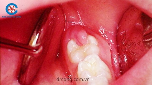 đau răng khôn nên làm gì