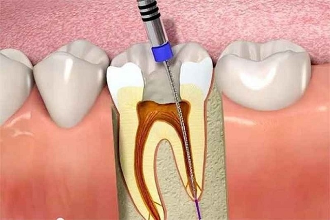 Điều trị tủy răng