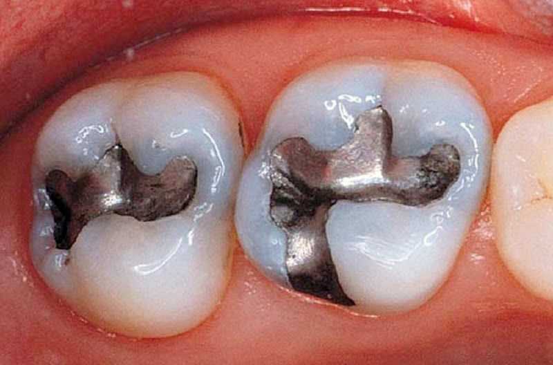 Phương pháp trám răng với vật liệu Amalgam