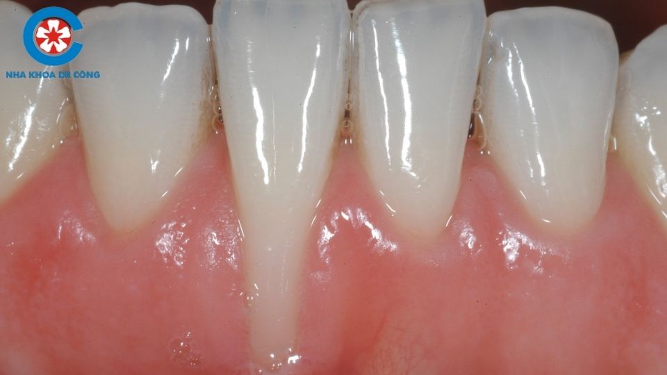 Tụt Lợi Chân Răng Là Gì? Cách Điều Trị Tụt Lợi Chân Răng