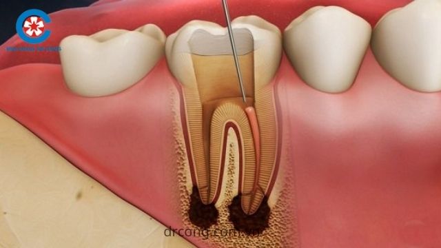 điều trị tủy răng