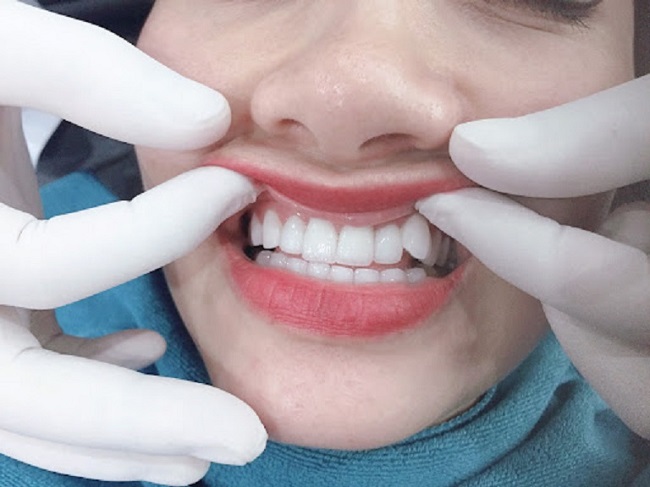 Cách làm răng khểnh tự nhiên bằng cách bọc răng sứ