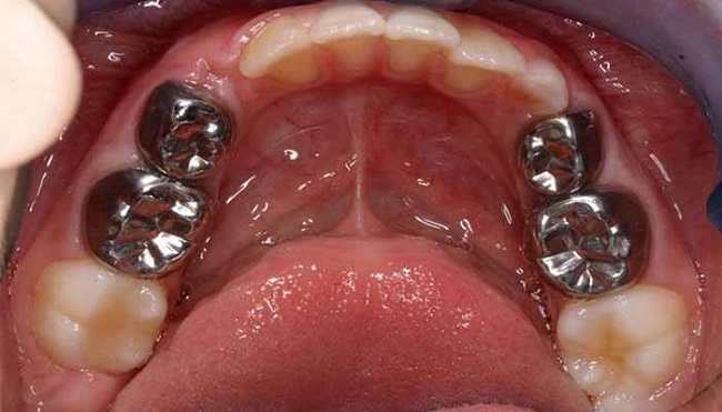 Bệnh nhân bị sâu răng nặng