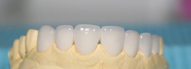 Bảo hành về răng sứ Zirconia