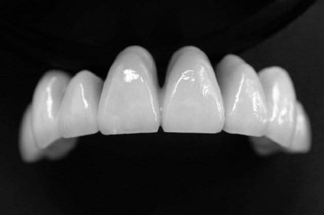 Răng Sứ Cercon là gì? Có nên Bọc Răng Sứ Cercon hay Không?