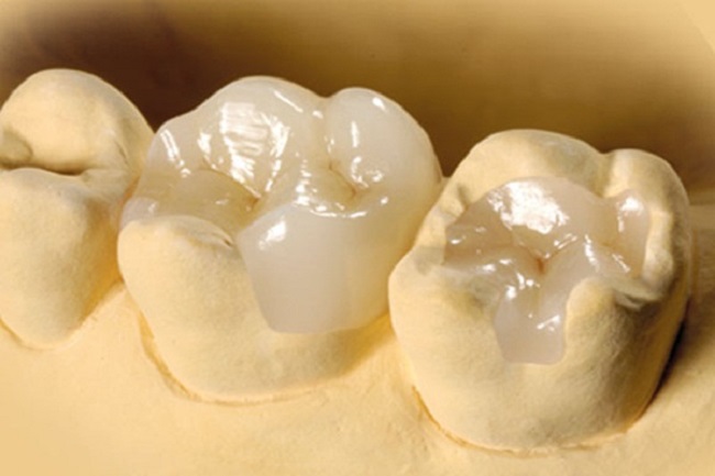 Trám răng từ vật liệu sứ Inlay – Onlay