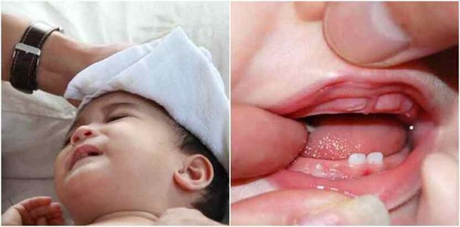 Trẻ Sốt Mọc Răng Mấy ngày? Cách Chăm Sóc Bé Nhanh Khỏi