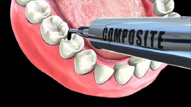 Vật liệu hàn răng Composite