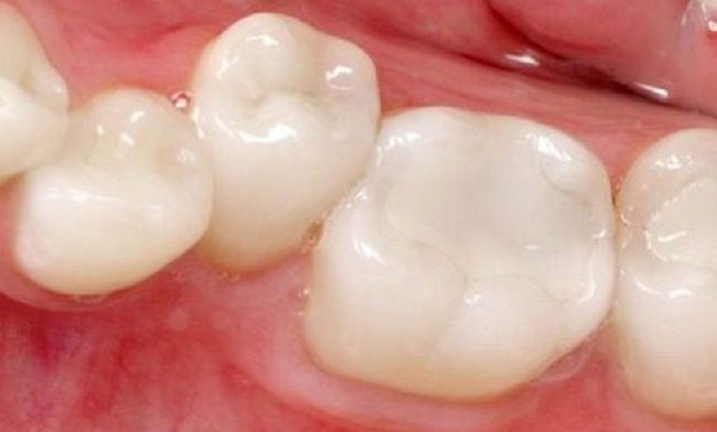 Vật liệu hàn răng GIC