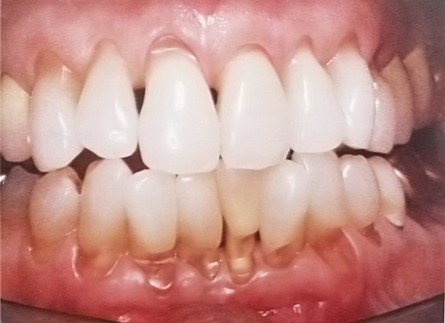 Hở Chân Răng Là Gì? Cách Chữa Hở Chân Răng An Toàn