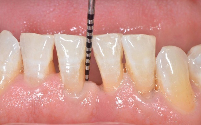 Hở Chân Răng Là Gì? Cách Chữa Hở Chân Răng An Toàn