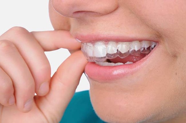 Niềng răng trong suốt Invisalign