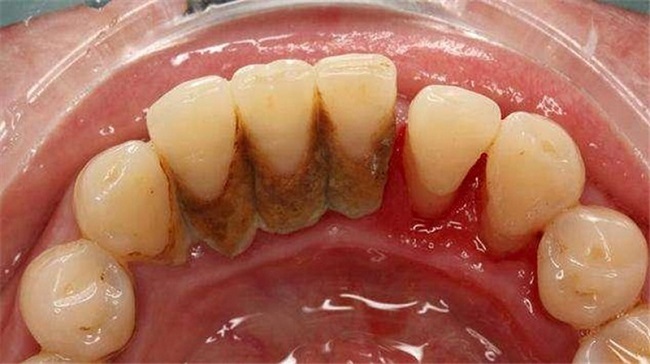 Lấy cao răng có tác dụng gì