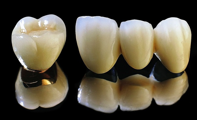 Răng sứ kim loại mỹ