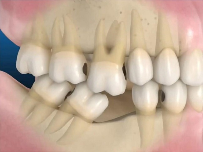Trồng răng hàm