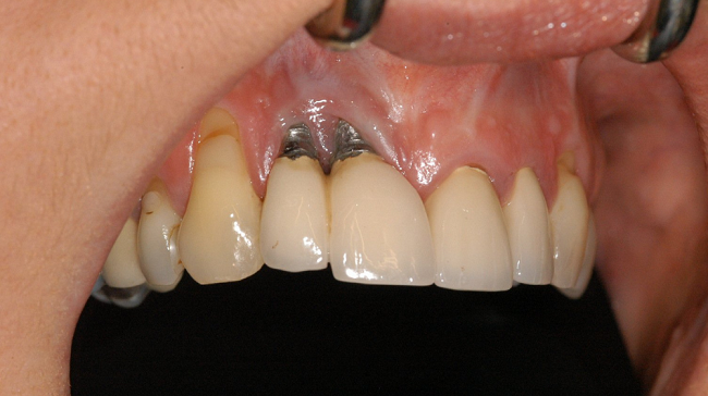 Trồng răng Implant có nguy hiểm không?