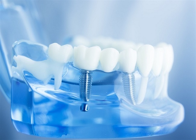 Trồng răng Implant trả góp
