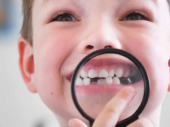 Có nên nhổ răng khi trẻ bị áp xe răng sửa không