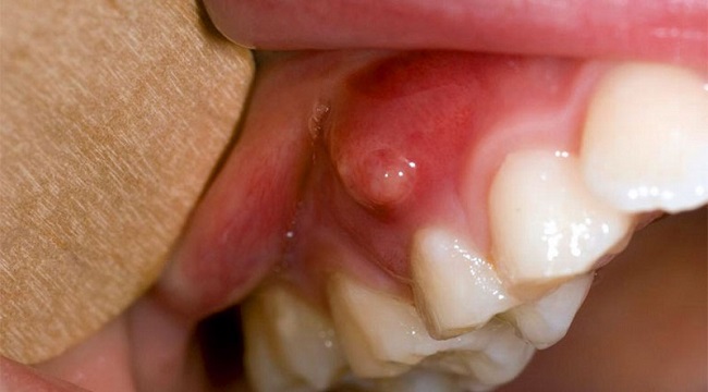 Đau nhức răng do áp xe