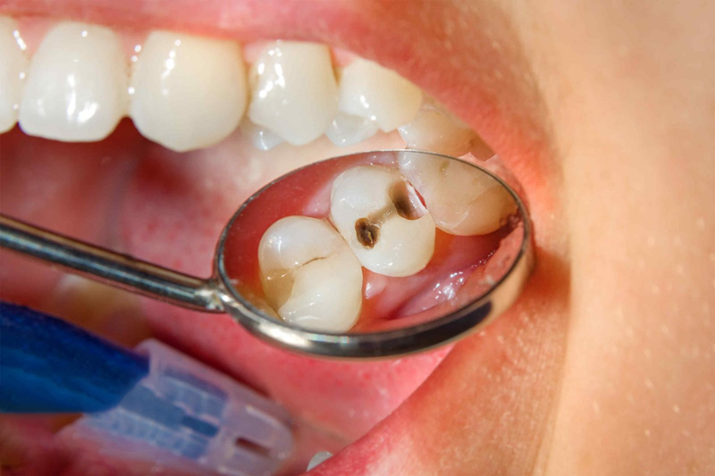 Giải Đáp: Có Kinh Lấy Tuỷ Răng Được Không?