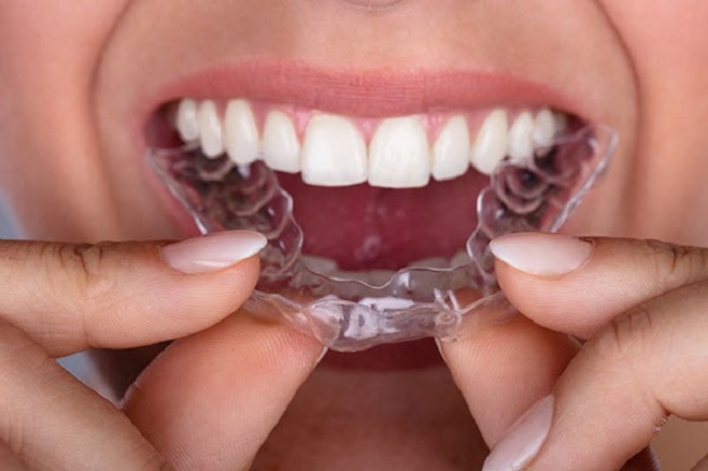Niềng răng invisalign 1 hàm