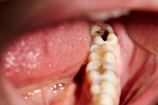 Viêm tủy răng khôn có nguy hiểm không
