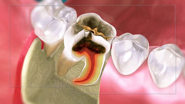 Viêm tủy răng số 6, 7 có nguy hiểm không?