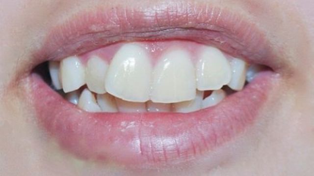 Cách khắc phục răng cửa to