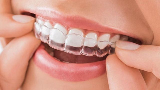 Phương pháp chỉnh răng hô không cần niềng