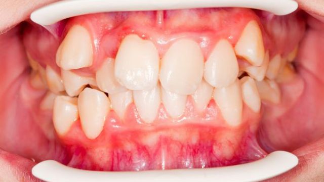 Răng mọc lệch lạc là mắc bệnh gì