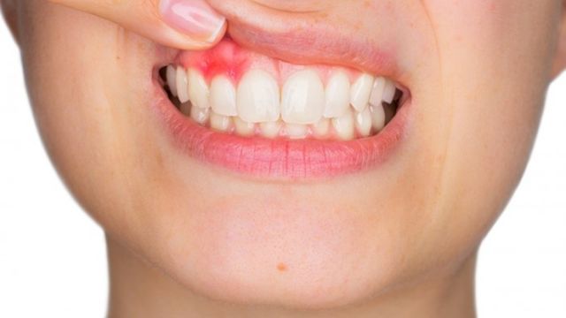 Tác hại của thuốc lá điện tử đến răng miệng