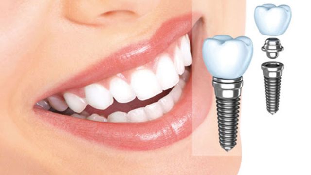  Trồng răng Implant răng hàm