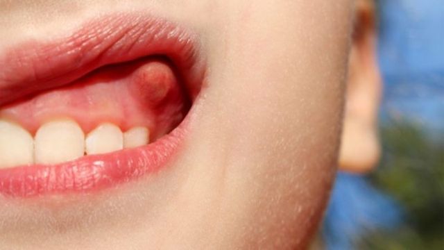 Chữa áp xe răng có được bảo hiểm không?