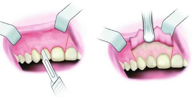 Phẫu thuật cắt chóp răng là gì