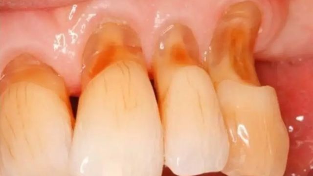 răng bị mục do đâu? Cách điều trị hiệu quả