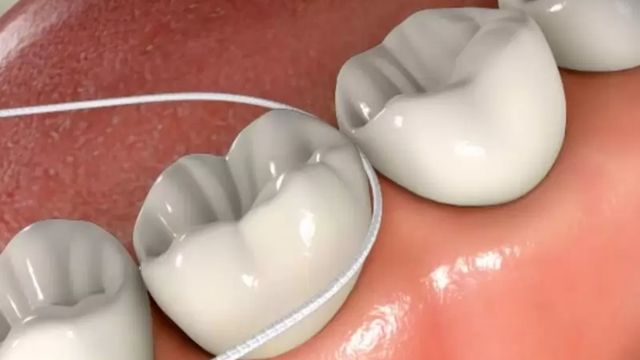 Răng bị vàng do hút thuốc có tẩy trắng răng được không