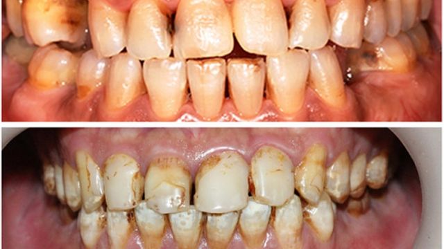 Răng bị vàng do hút thuốc có tẩy trắng răng được không