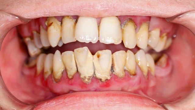 Mất răng lâu năm có trồng được răng không