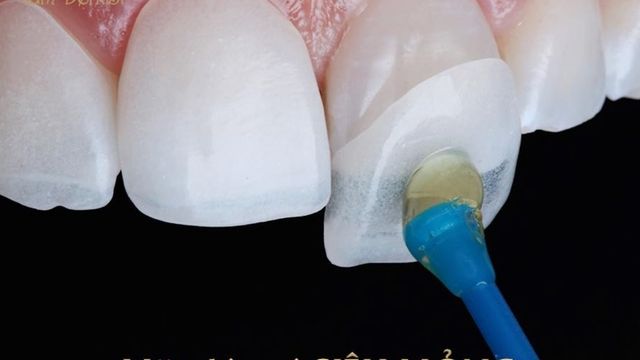 Tác hại của bọc răng sứ bị lệch khớp cắn